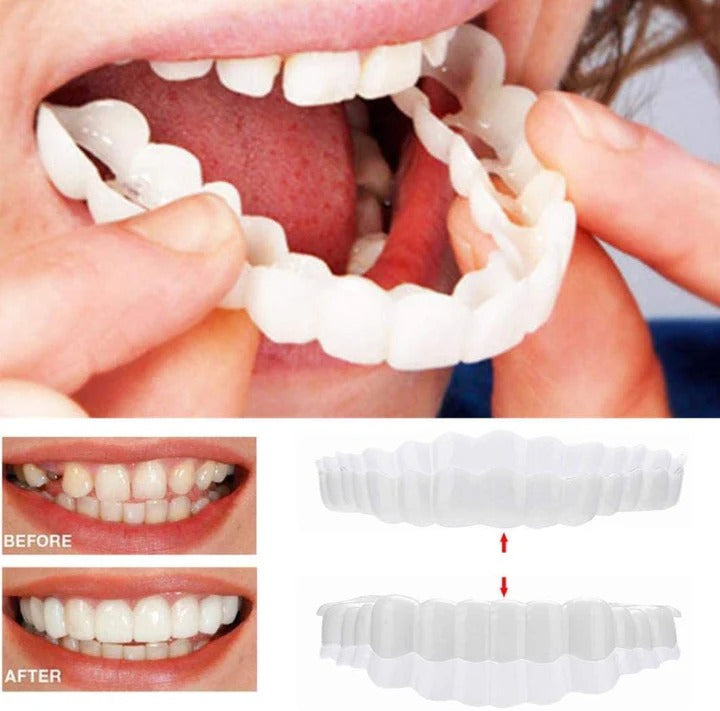 Lisslune | Removable Smile Veneers for Upper and Lower Teeth