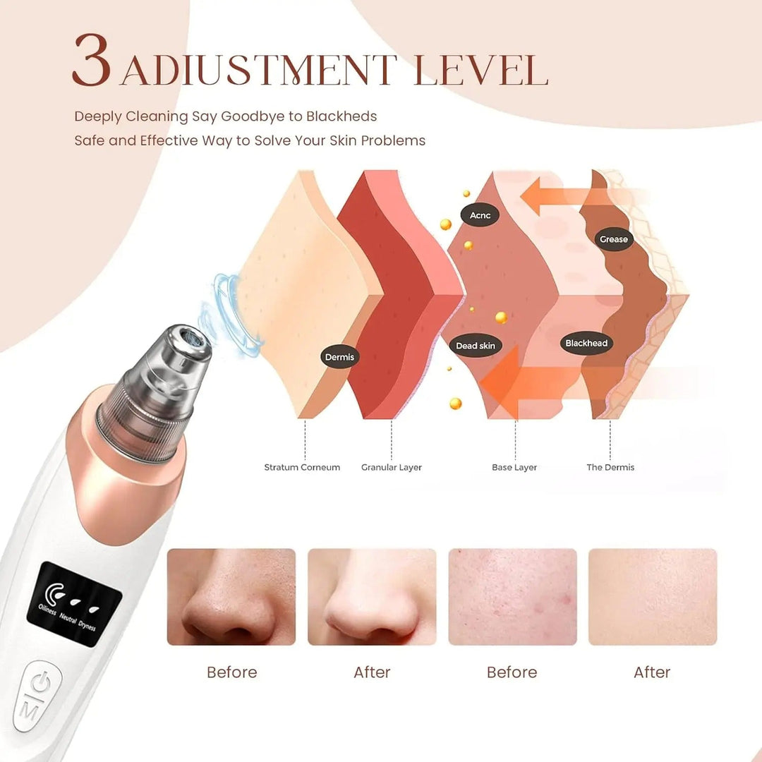 Lisslune | Blackhead Remover Vacuum Pore Cleaner | Adjustable Suction, Multi-Functional Tool for Deep Cleansing & Acne Treatment at Home