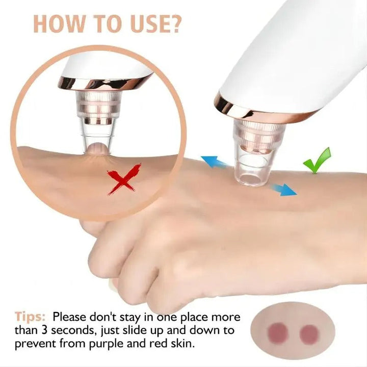 Lisslune | Blackhead Remover Vacuum Pore Cleaner | Adjustable Suction, Multi-Functional Tool for Deep Cleansing & Acne Treatment at Home
