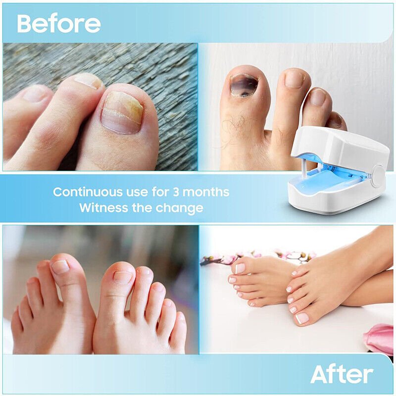Lisslune | Laser device for nail fungus cleaning – Revolutionary, highly efficient light therapy device from Expert for toe nail conditions