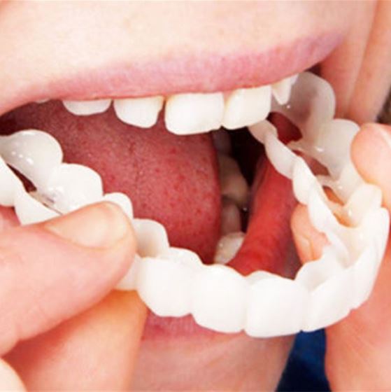 Lisslune | SmileSnap - Always the perfect smile with these veneers